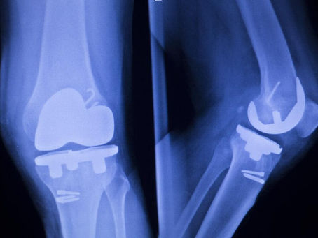 Myth or Science: Hip and Knee Replacement Can Last More than 25 Years