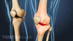 Osteoarthritis - What’s New?