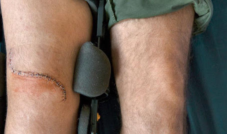 How Long Does a Knee Implant Last?