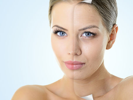 Rejuvenescimento Facial e das Sobrancelhas com menos cicatrizes: Endomidface e EndoBrow