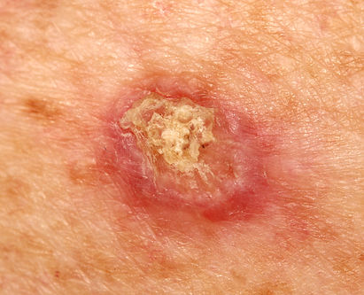A case of an invasive squamous cell carc