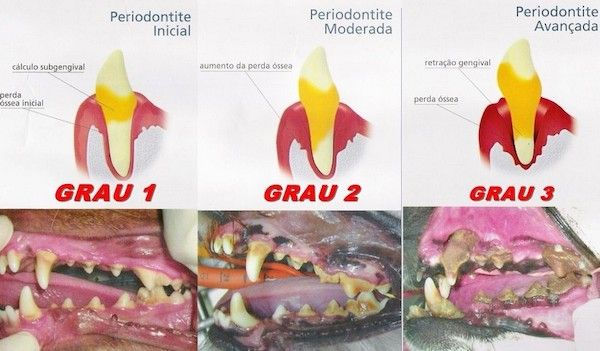 Três estágios da Doença Periodontal