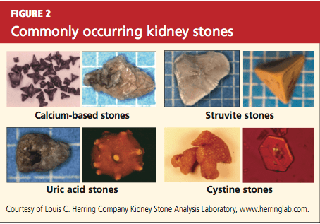 Kidney Stones