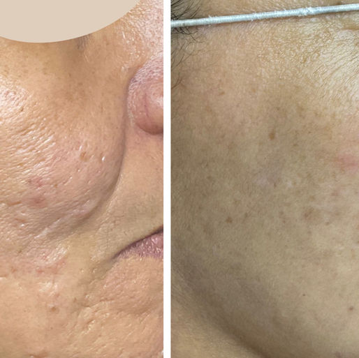 Ultherapy vs. Morpheus8: dos tratamientos que la gente confunde constantemente (y cómo saber cuál necesitas)