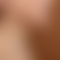 skin perimenopause