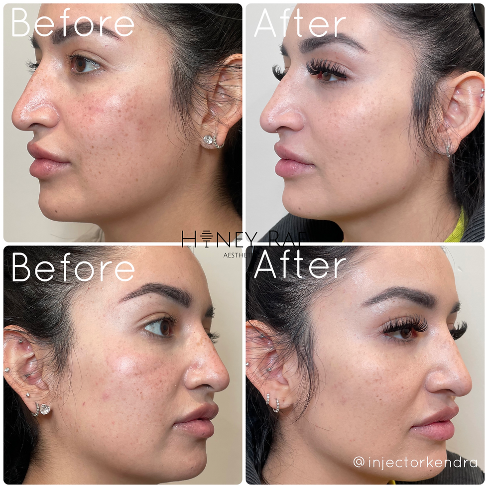 Lip filler touch-up results in Eagle Mountain by Kendra and Sage