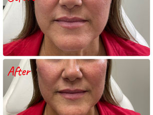Lip Filler in Eagle Mountain