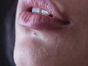 Lip Filler Touch-Ups in Eagle Mountain, Utah