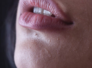 Lip Filler Touch-Ups in Eagle Mountain, Utah