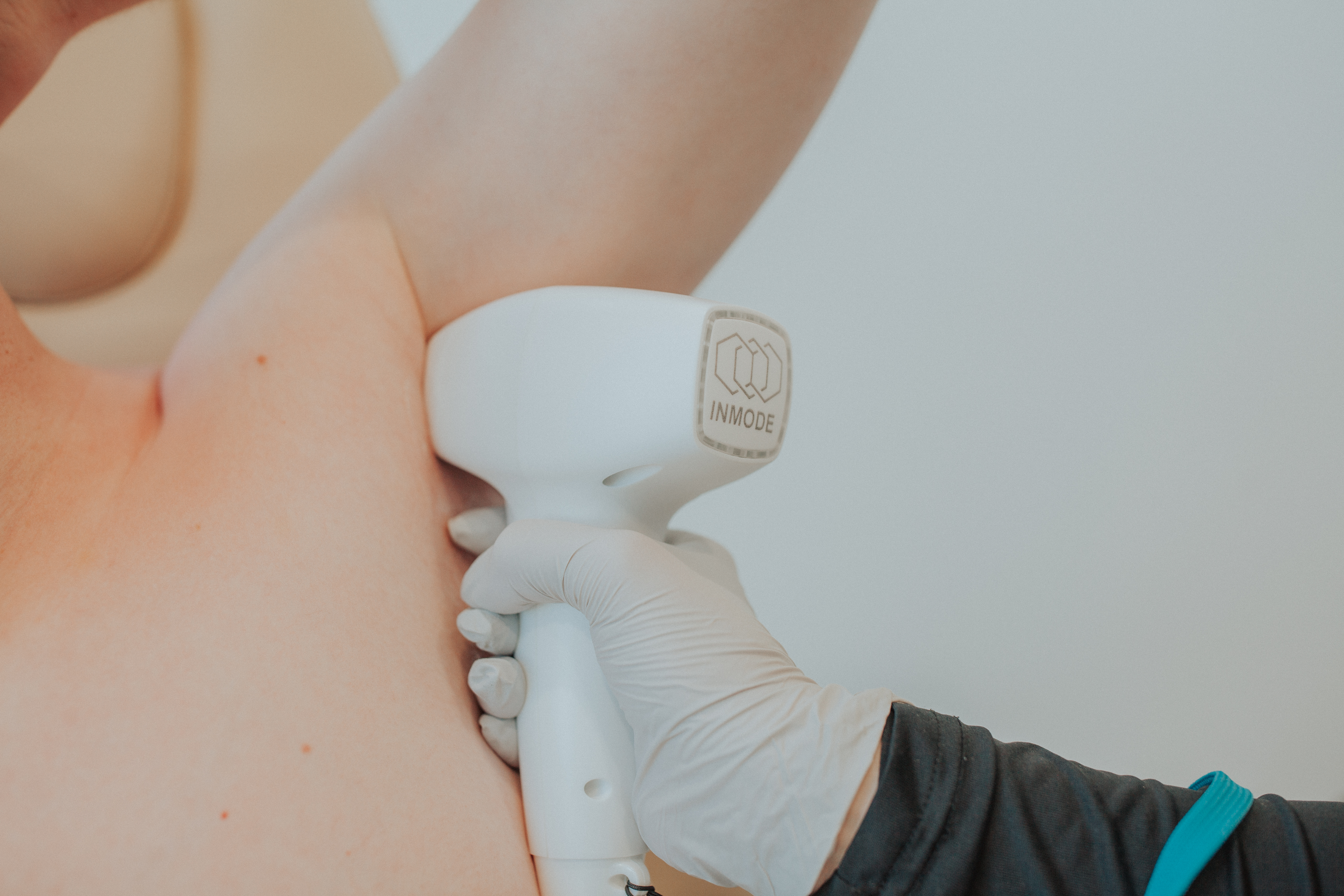 Laser Hair Removal Results