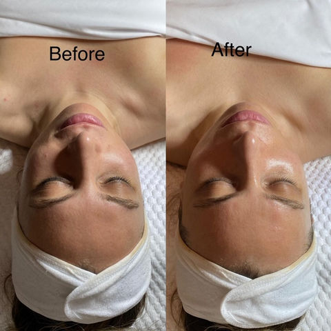 Before and after pic of a woman after microdermabrasion facial at Idan Med Spa San Francisco