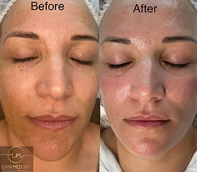 Before and after Nano needling facial Idan Med Spa San Francisco
