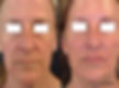 Red Carpet Facial Idan Med Spa