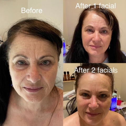 Before and after pic of a woman after 2 non surgical facelift facials at Idan Med Spa San Francisco