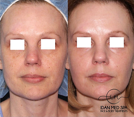 Resurface Renewal Facial_edited.jpg