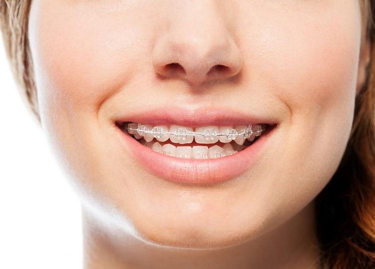 braces-made-from-wire-and-acrylic.jpeg