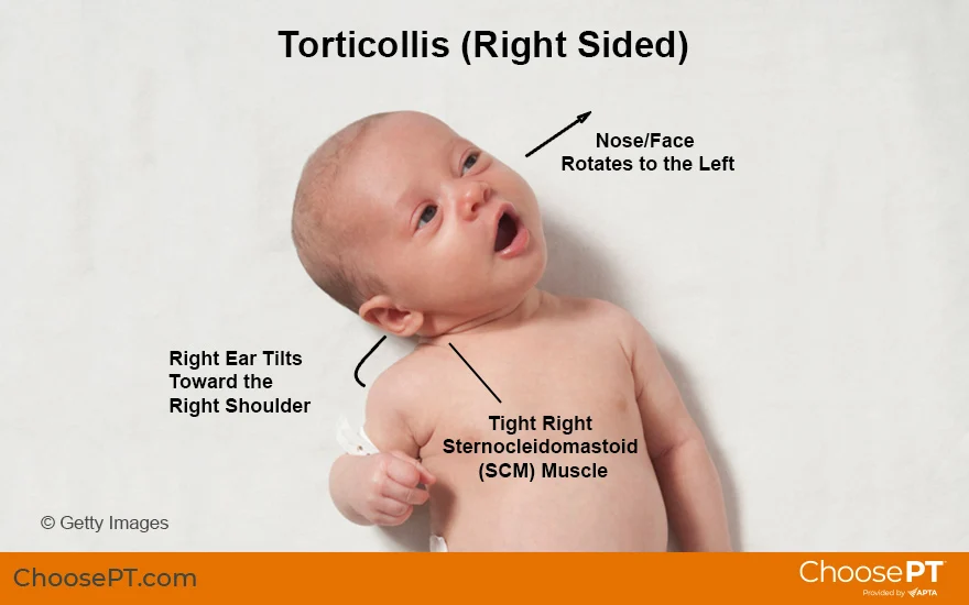 torticollis_choosept_illustration_880x550.webp