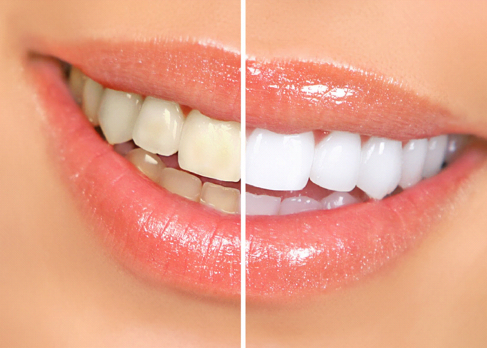 BLANQUEAMIENTO DENTAL | puntodentalmx