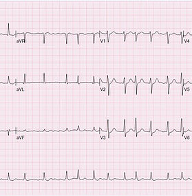 Atrial Fibrillation