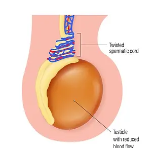 Testicular Torsion