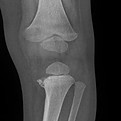 Corner Fracture.jpeg