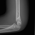 Supracondylar Fracture