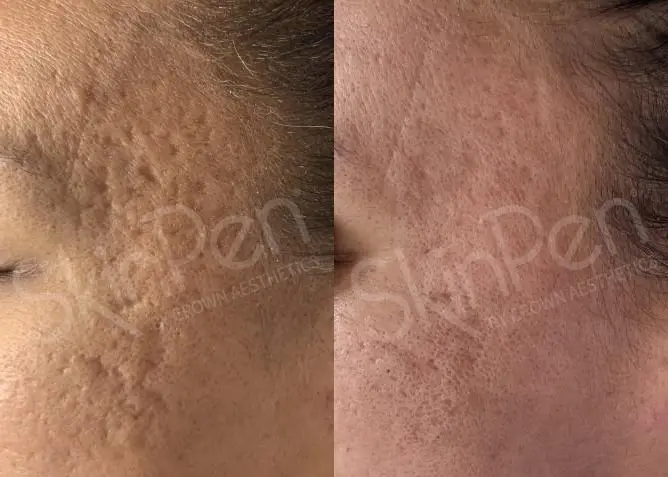 skinpen-before-and-after-Lu2PYyX1t74s_highres