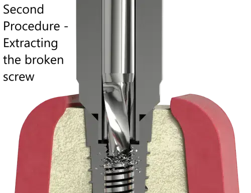 DENTAL SCREW REMOVAL: A REVOLUTION WITH TELCON’S BHI SCREW REMOVAL KIT