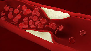 Blocked Arteries? Know Your Treatment Options.