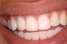 Image of an tooth implant replacement