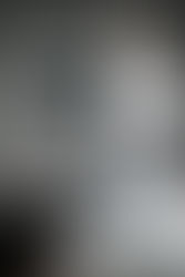 Monitorización de la respuesta a inmunoterapia en adenocarcinoma de pulmón PD-L1 positivo mediante 18F- FDG PET/TC