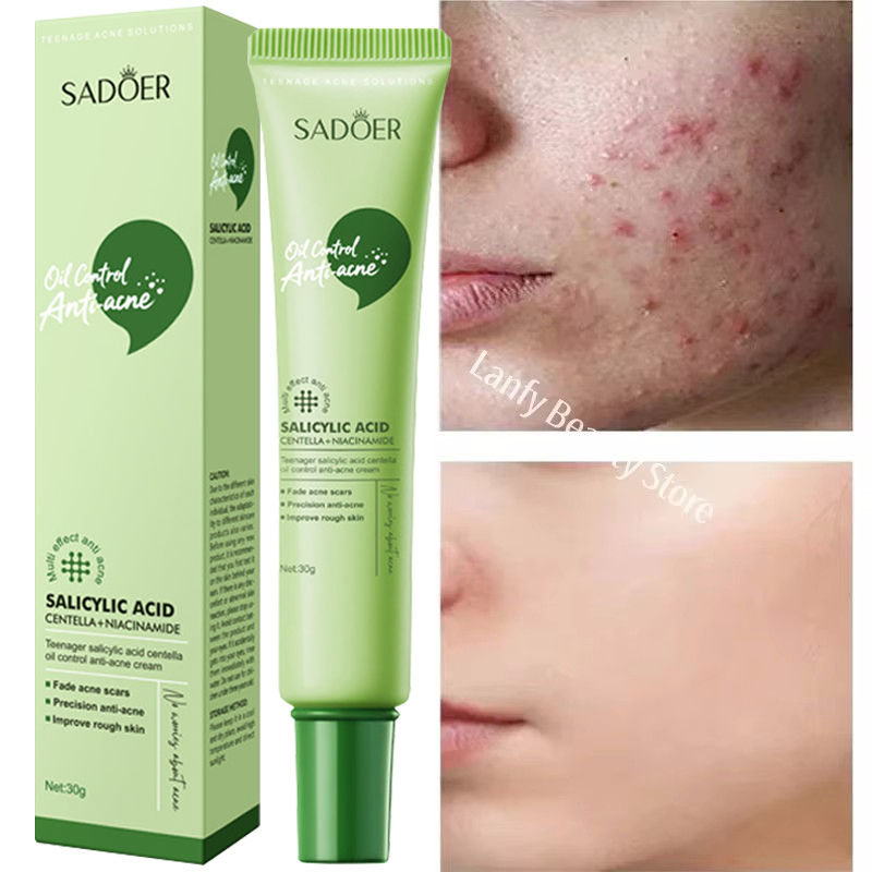 Salicylic Acid Acne Treatment Face Cream Repair Pimple Spots Deep Cleaning