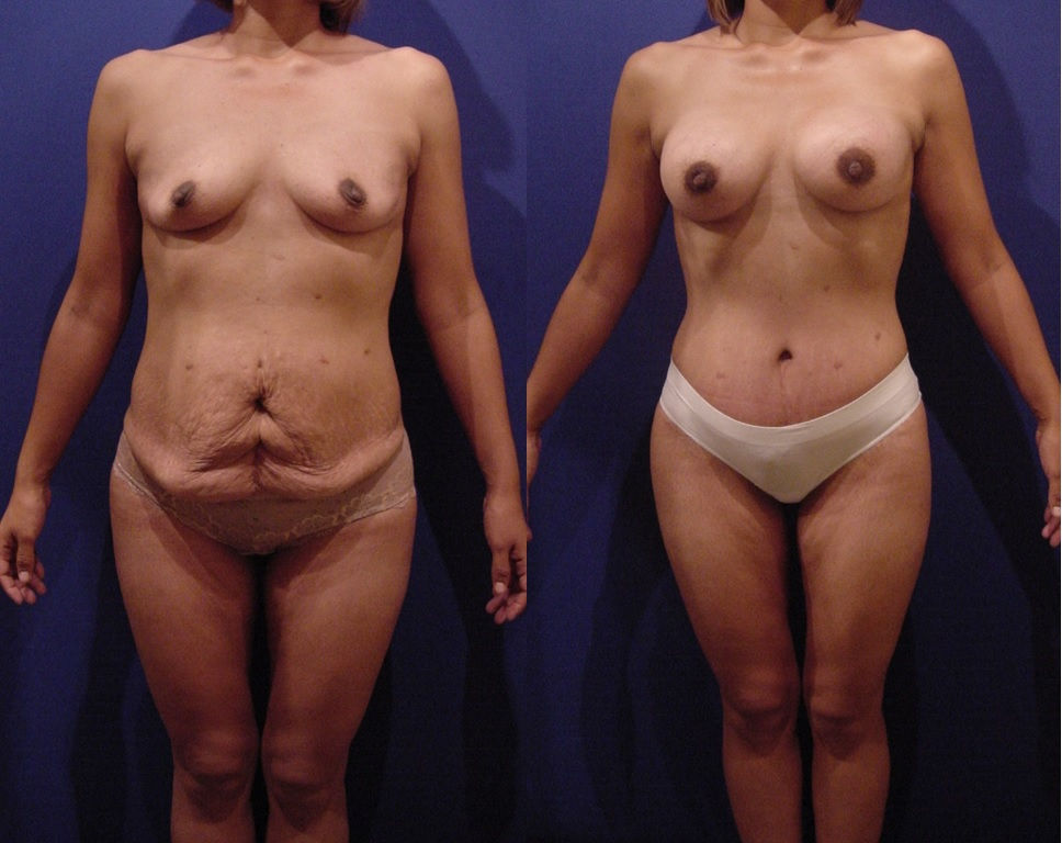 Abdominoplastía Antes y Después.