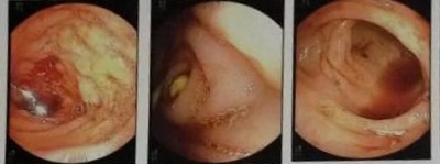 15 Month Old Baby infant had symptoms like Chronic Diarrhea content media