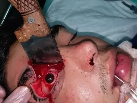 Stab wound to the face!