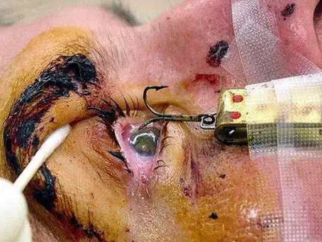 Fishing hook accident