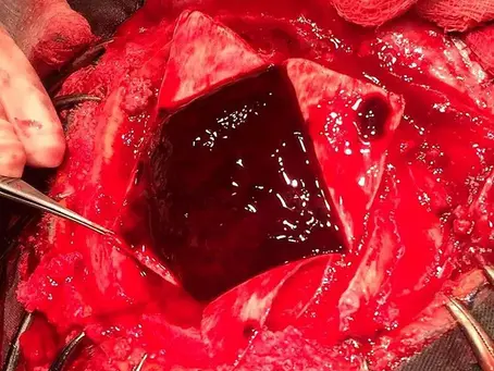 Bleeding into the brain!