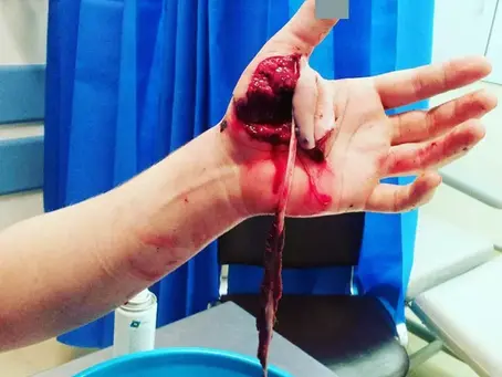 Gunshot wound to the hand