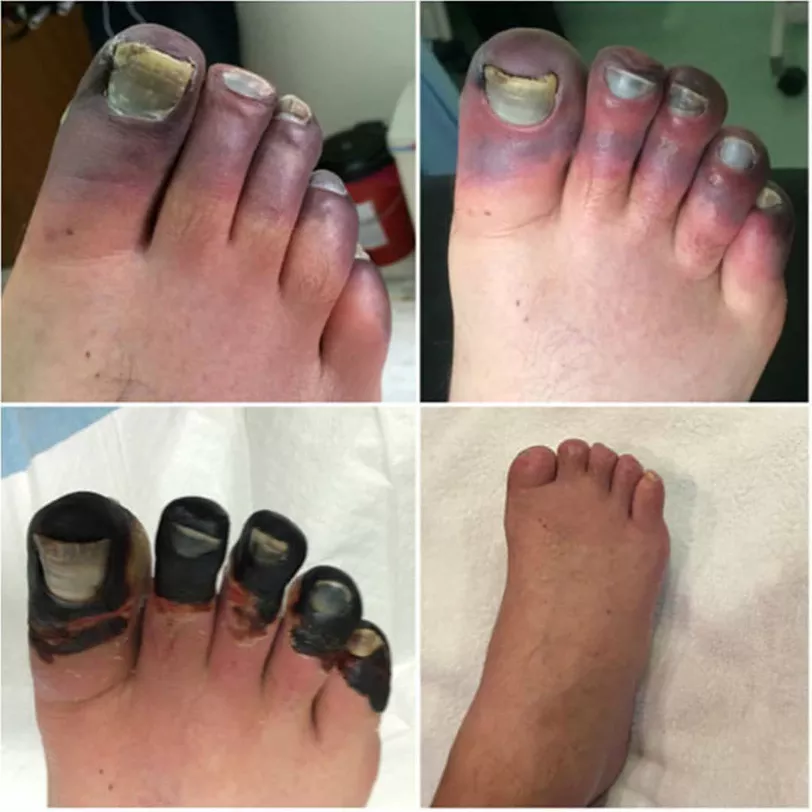 Severe frostbite in extreme altitude climber (Mt. Everest)