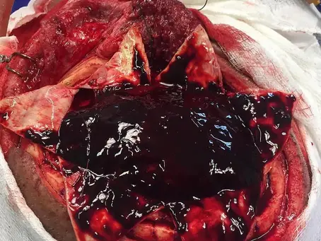 Massive subdural hematoma over the surface of the brain!