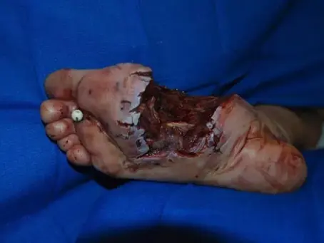 A case of an accidental gunshot wound to the foot while hunting!