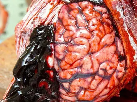 Huge subdural hematoma!