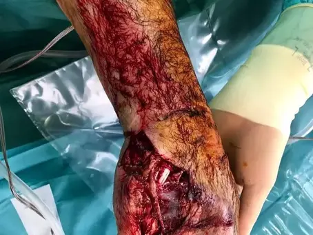 Severe crush injury to the hand