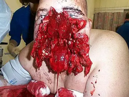 Shotgun injury to the face