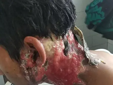 Extreme acid burn all over the neck region!