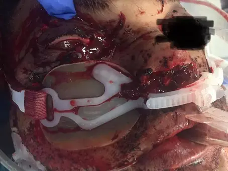 Extensive facial trauma after being ejected from the vehicle!