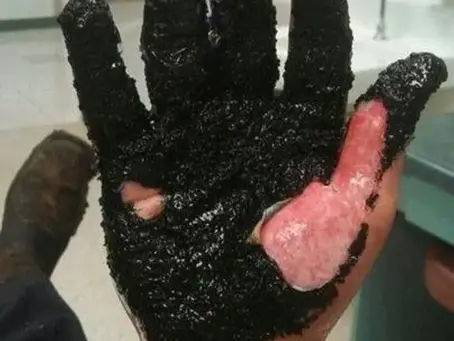 A case of 500-degree hot asphalt stuck on the patient's hand causing severe burns.