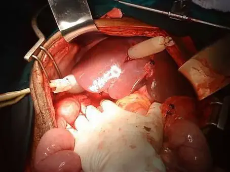 Horrific liver injury!