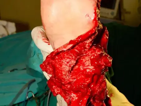 Foot injury caused by RTA!