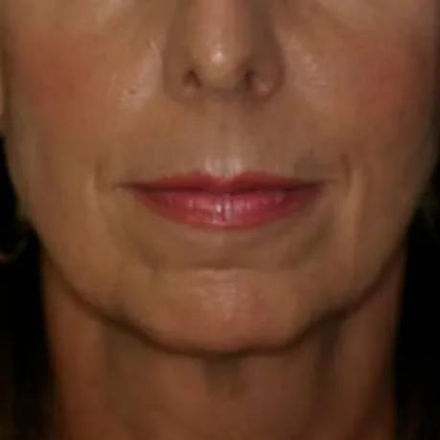 smoothlase facial rejuvenation
